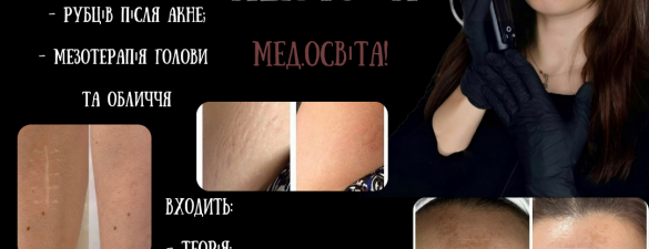 Мікронідлінг (видалення шрамів, розтяжок, рубців після акне). Онлайн навчання